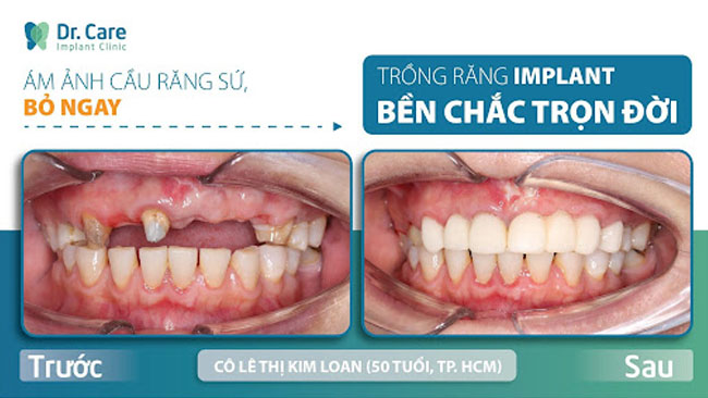 Trồng răng Implant All On 4, All On 6 đối với trường hợp mất răng toàn hàm