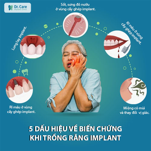 5 dấu hiệu về biến chứng khi trồng răng Implant cần lưu ý
