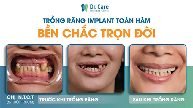 Mất răng bao lâu thì trồng răng giả được