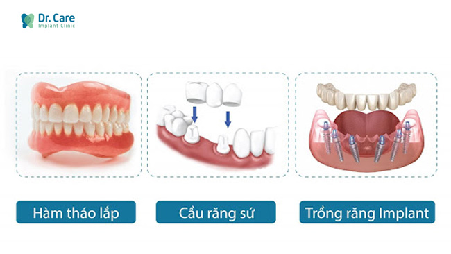 Trồng răng Implant là phương pháp tối ưu nhất trong 3 phương pháp phục hồi răng