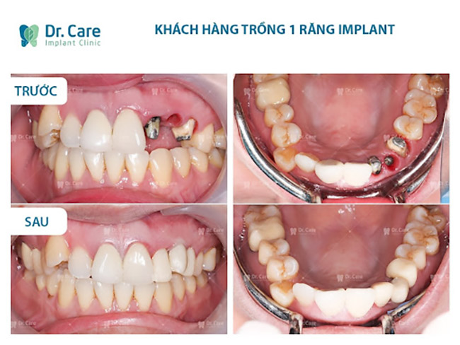 trồng răng implant có bền không