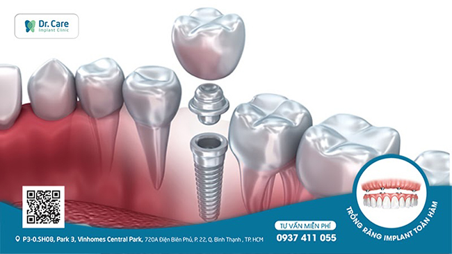 Trụ Implant được làm bằng titanium cao cấp, dễ dàng tích hợp xương.