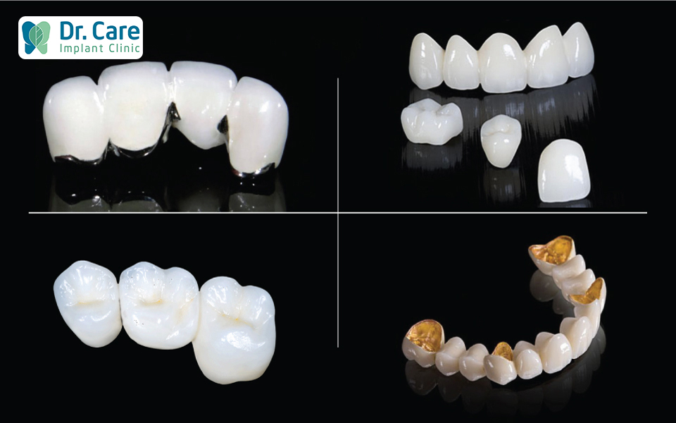 Các loại răng sứ có thể lựa chọn khi bọc răng sứ