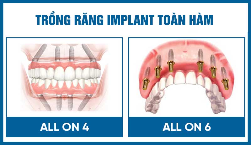 Dịch vụ trồng răng Implant toàn hàm tại Dr. Care