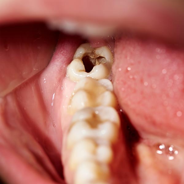 Răng cấm bị hư có nguy hiểm không?