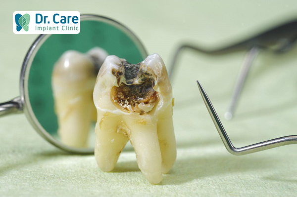 Răng cấm bị hư do những nguyên nhân nào?