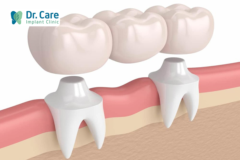 Viêm lợi sau khi bọc răng sứ hoặc làm cầu răng sứ dẫn đến viêm nha chu như thế nào?