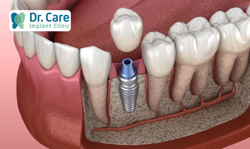 Trồng răng Implant khắc phục tình trạng viêm nha chu sau khi làm cầu răng sứ như thế nào?
