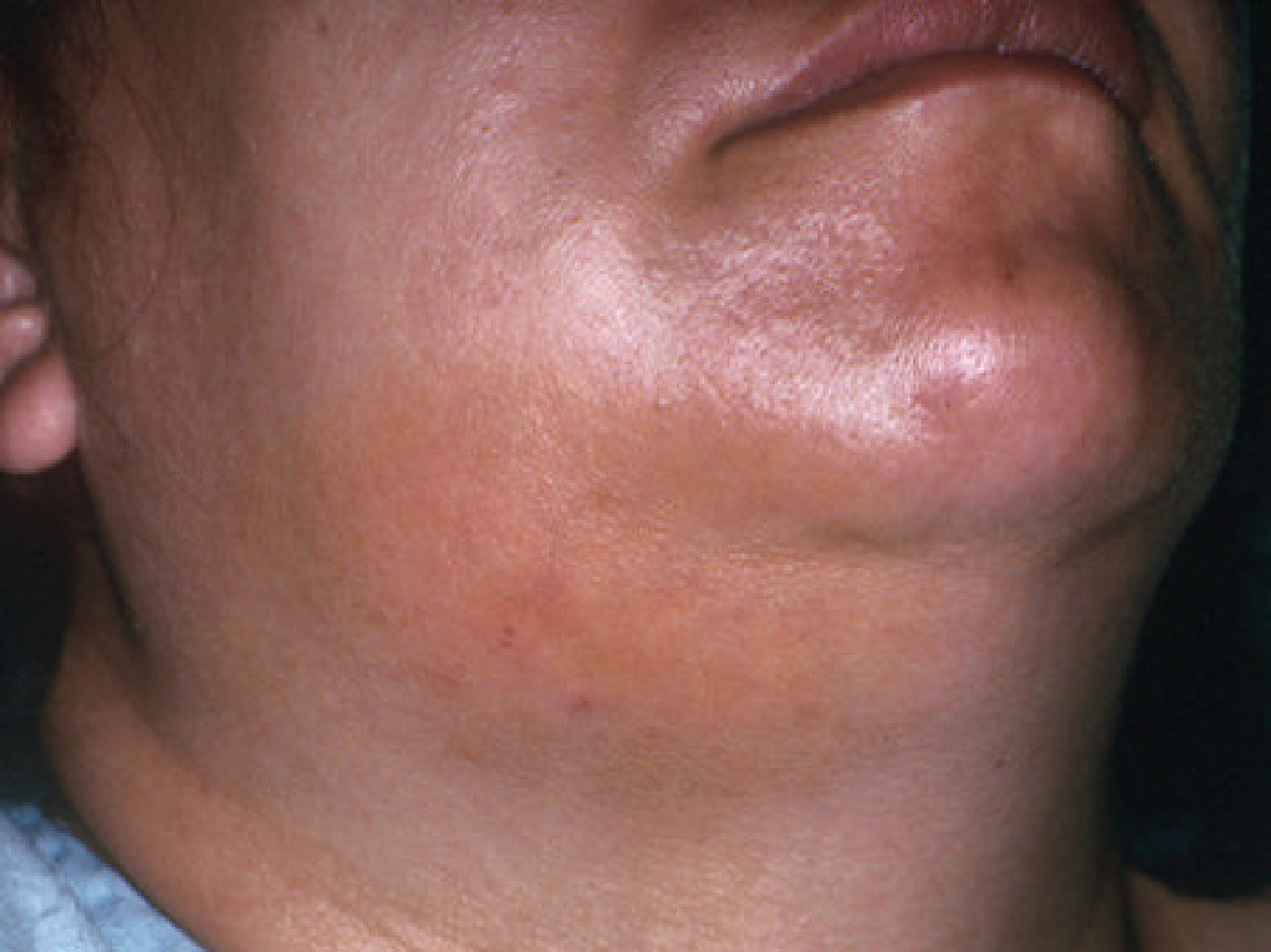 Triệu chứng của viêm nhiễm vùng hàm mặt