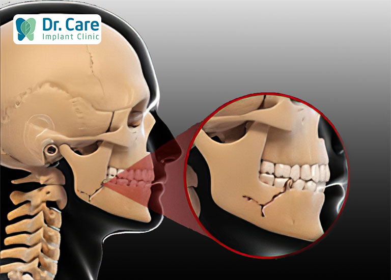 Chấn thương, tai nạn vùng xương hàm