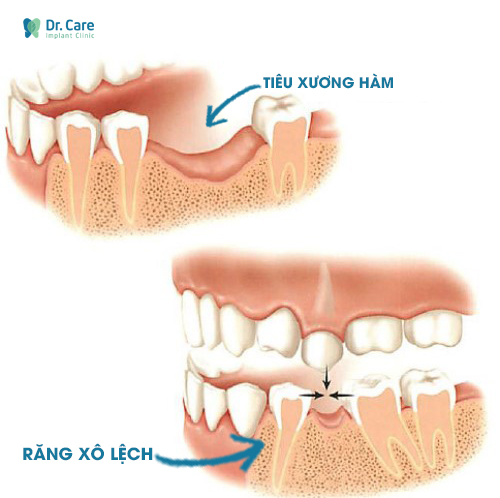 Vì sao mất răng gây ra hiện tượng lệch hàm