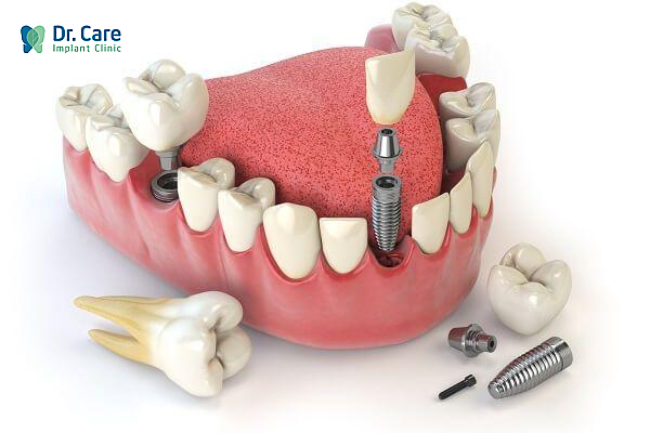 trồng răng implant dùng được bao lâu