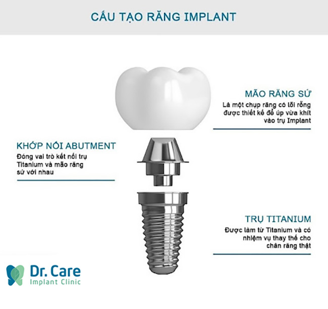 abutment implant là gì