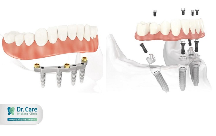 trồng răng implant all on 4