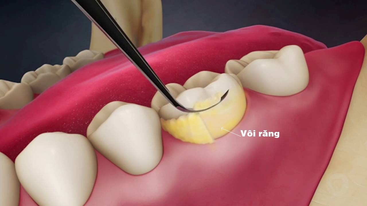 Bị sưng nướu răng có mủ: nguyên nhân và cách điều trị hiệu quả