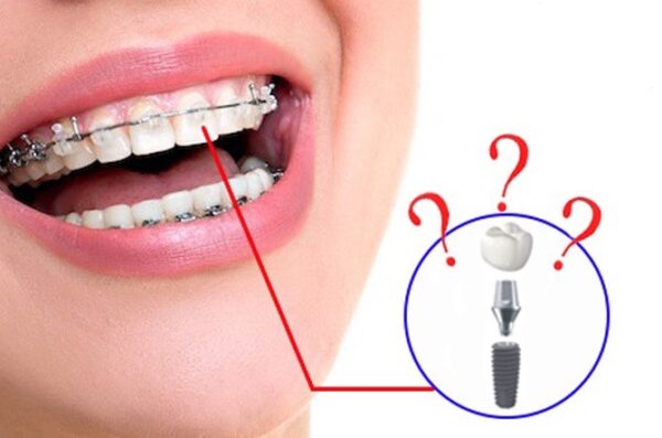 phương pháp phục hình khác như Implant có niềng răng được không?