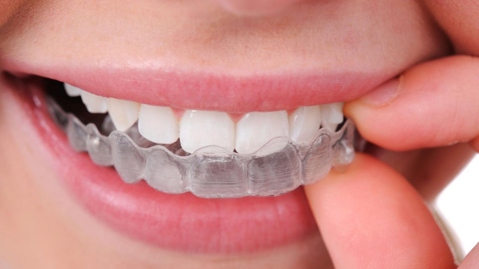 Tổng hợp các cách làm trắng răng an toàn và hiệu quả