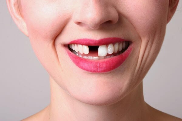 cách trồng răng cửa bằng cấy ghép Implant