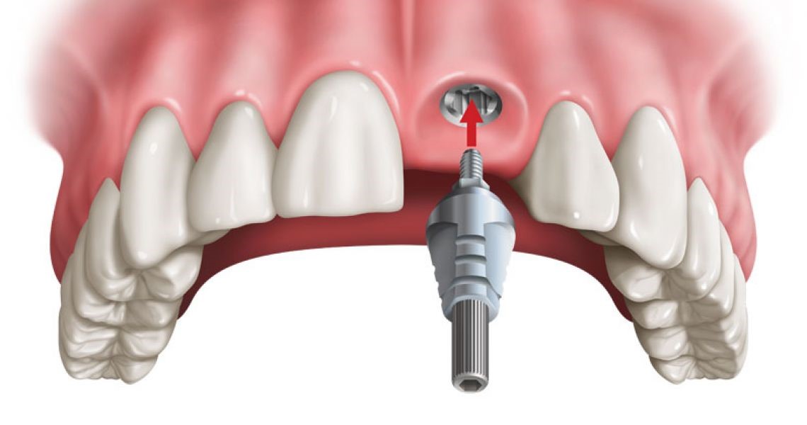 cách trồng răng cửa bằng cấy ghép Implant