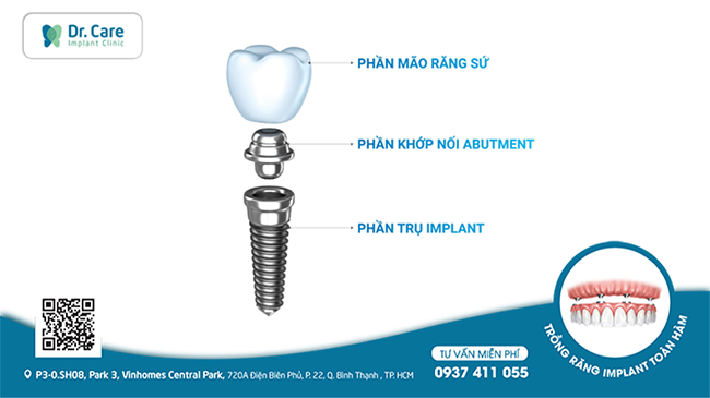 Sau khi cấy ghép, răng Implant sẽ đảm bảo chức năng ăn nhai và thẩm mỹ gần như răng thật