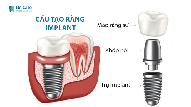 Răng implant có cấu tạo tương tự như răng thật