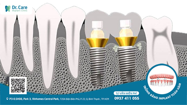 Hệ thống rãnh kép trên thân kết hợp cùng thiết kế côn thuôn nhọn giúp Implant Dentium Superline vững ổn trong xương hàm.