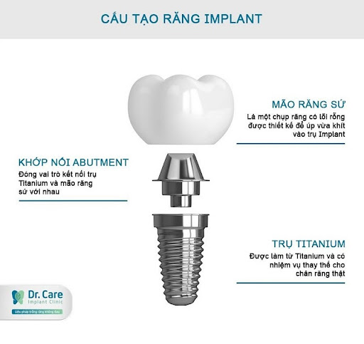 Trụ Implant có cấu tạo tương tự như răng thật, nên đảm bảo chức năng ăn nhai đạt 90% răng thật