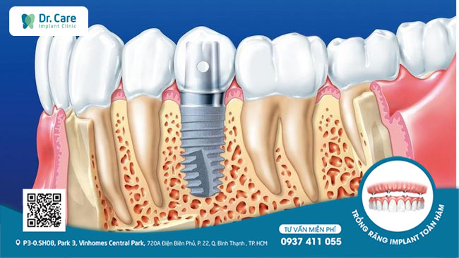 Trụ Implant được chế tạo từ titanium, một vật liệu đặc biệt có khả năng tích hợp vào xương hàm. Vì thế hoàn thành quá trình cấy ghép implant khách hàng có thể ăn nhai thoải mái.