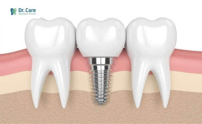 Cấy ghép Implant thay cho cầu răng sứ