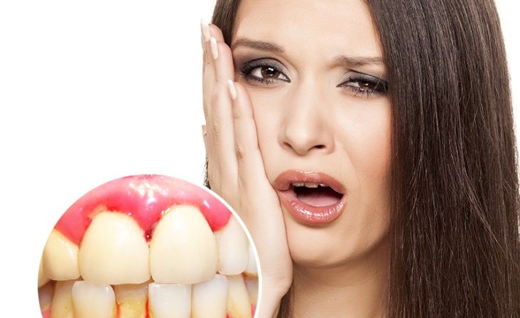 Chảy máu chân răng: Nguyên nhân và cách điều trị