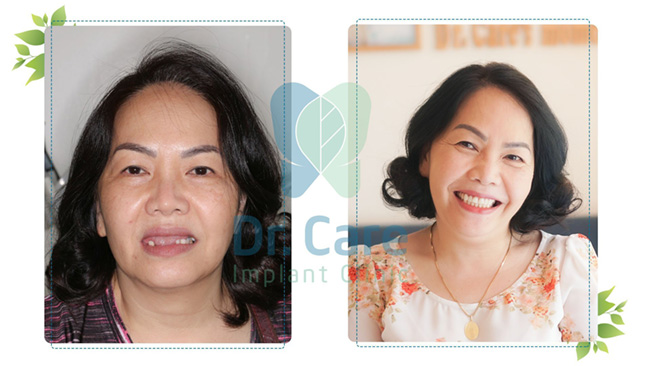 Tại Dr. Care trụ Implant Dentium Superline được sử dụng cho ca phẫu thuật cấy ghép Implant toàn hoàn của Cô Mỹ Hạnh (55 tuổi, TP HCM). 