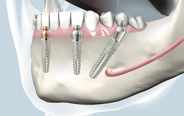Trồng răng Implant - công nghệ làm răng giả mới nhất hiện nay