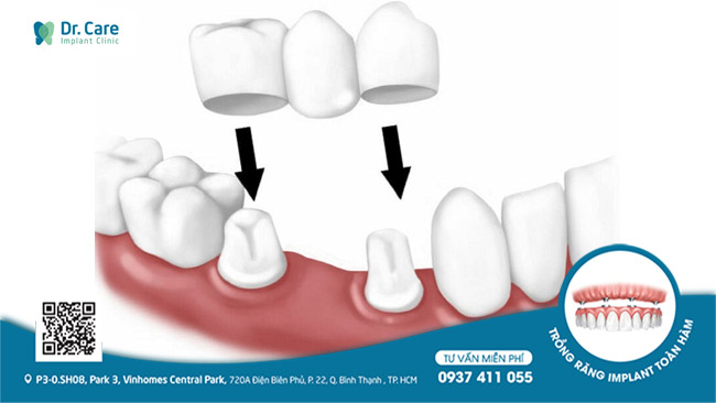 2 răng thật kế cận bị mài để làm trụ răng, lâu ngày sẽ dẫn đến tình trạng sâu răng, mất luôn răng thật
