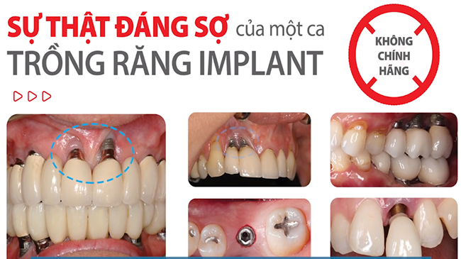 Trồng răng implant giá rẻ, không đạt tiêu chuẩn dễ dẫn đến nguy cơ implant bị đào thải