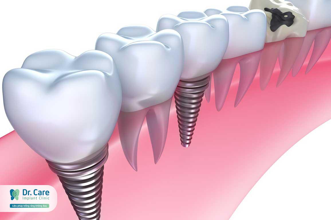 Răng Implant có cấu tạo gần như răng thật
