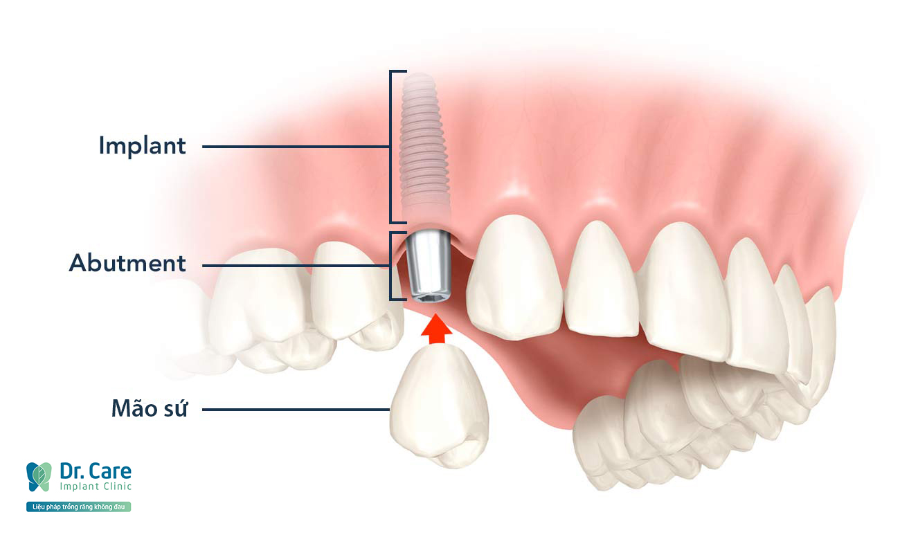 Cấu tạo răng Implant gồm 3 phần trụ Implant, Abutment và Mão sứ