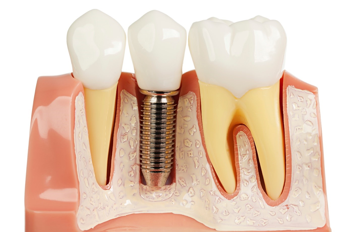 Cấu tạo và vị trí các thành phần của răng Implant trong xương hàm