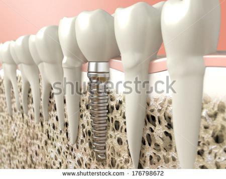Răng Implant có thể thay thế hoàn toàn chức năng của một chiếc răng thật