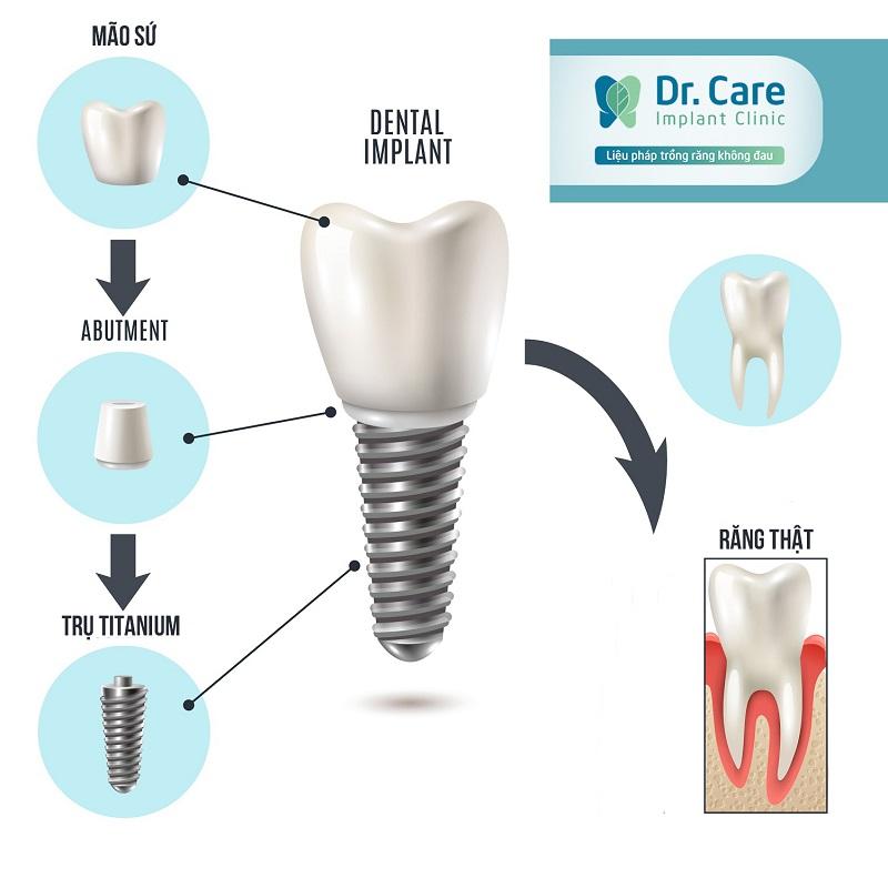 Người gặp khó khăn với hàm tháo lắp hoặc không muốn làm cầu răng có thể chọn trồng Implant
