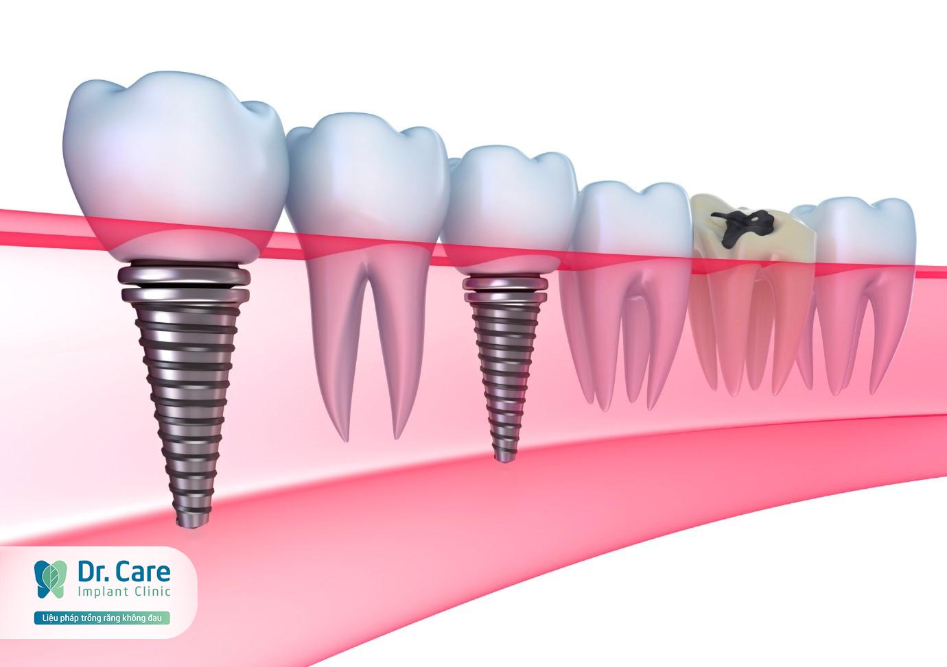 Răng Implant có cấu tạo tương đương răng thật