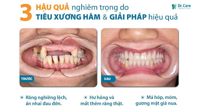 Mất răng lâu ngày, không trồng răng implant sẽ dẫn đến những hậu quả nghiêm trọng