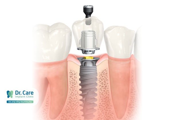 trụ implant nobel biocare