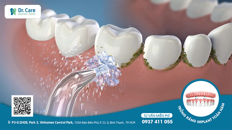 khắc phục răng implant bị lung lay