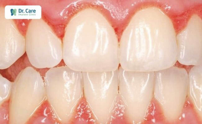 Làm cầu răng sứ sai kỹ thuật, tay nghề bác sĩ kém có thể dẫn đến biến chứng viêm lợi