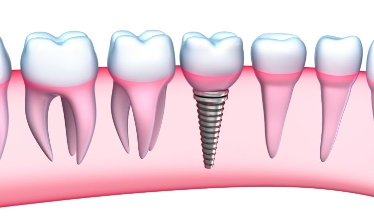 trồng răng Implant không lo hôi miệng