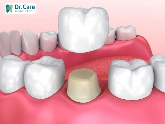 Phân biệt cách dùng mão răng sứ khi chụp (bọc) răng sứ, trồng răng sứ và mão răng sứ trên Implant?