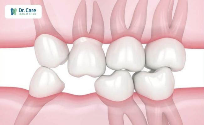 Tại sao mất răng gây ra rối loạn khớp thái dương hàm?