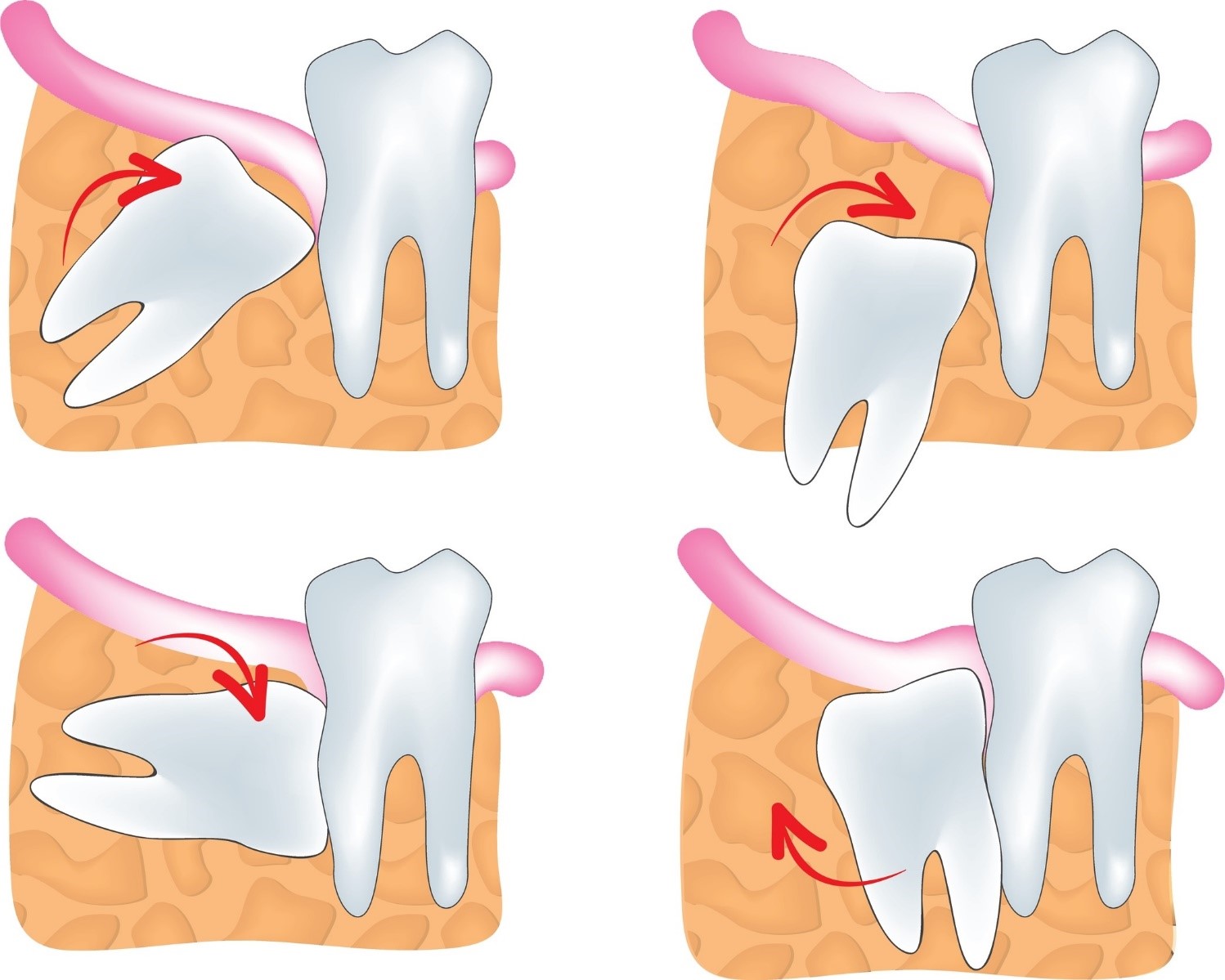 Top 5 nguyên nhân gây đau răng phổ biến hiện nay