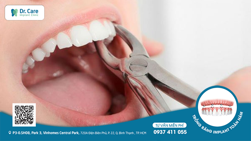nhổ răng trồng răng implant