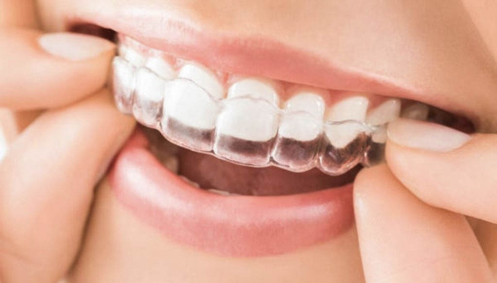 Niềng răng Invisalign